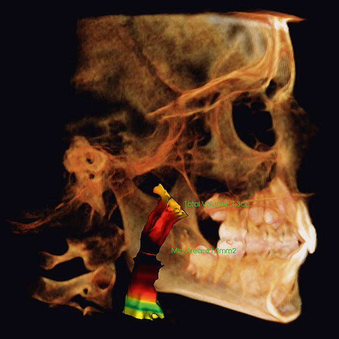Dexis 3D Vision V17