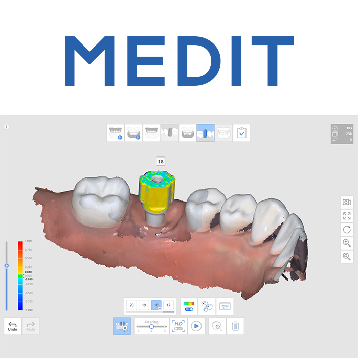 Implantátum szkennelés