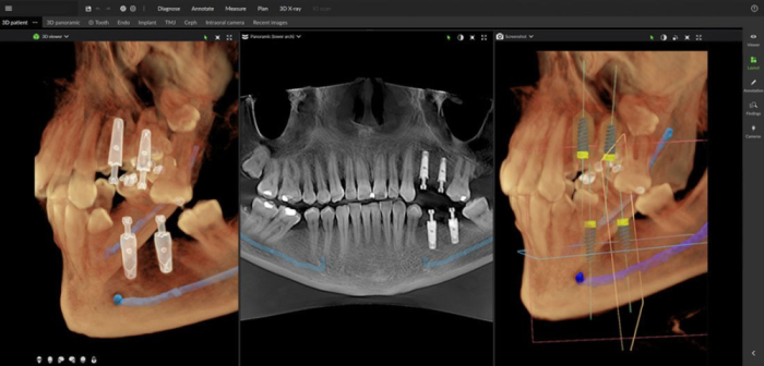 Dexis OP 3D™ LX 15x20 FOV Ceph. Dexis OP 3D™ LX 15x20 FOV Ceph.
