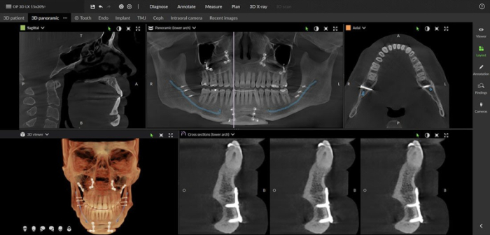 Dexis OP 3D™ LX 15x20 FOV Ceph. Dexis OP 3D™ LX 15x20 FOV Ceph.