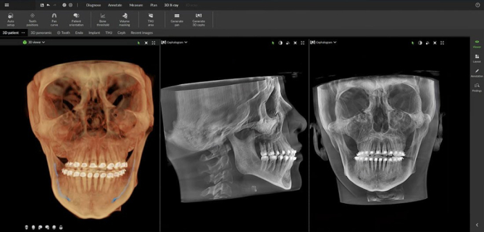 Dexis OP 3D™ LX 15x20 FOV Ceph. Dexis OP 3D™ LX 15x20 FOV Ceph.