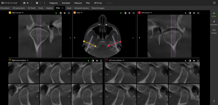 Dexis OP 3D™ LX 15x20 FOV Ceph. Dexis OP 3D™ LX 15x20 FOV Ceph.
