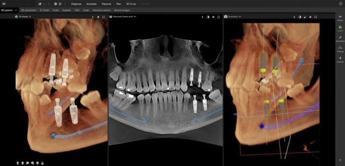 Dexis OP 3D™ EX 10x11 FOV Dexis OP 3D™ EX 10x11 FOV